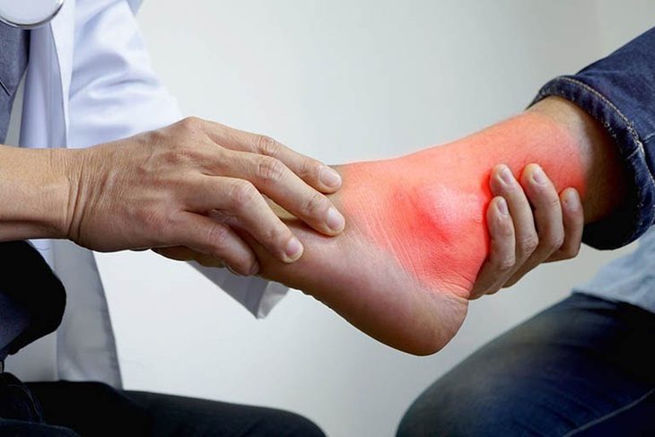Ăn kiêng sao gút vẫn đau? - Ảnh 1. Chân sưng đau vì ăn chay trị gút - Ảnh minh họa
