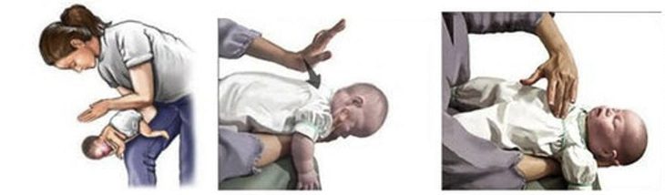 Khi phát hiện trẻ sặc sữa cần tiến hành cấp cứu càng sớm càng tố - Ảnh minh họa: Bệnh viện cung cấp Khi phát hiện trẻ sặc sữa cần tiến hành cấp cứu càng sớm càng tốt - Ảnh minh họa: Bệnh viện cung cấp
